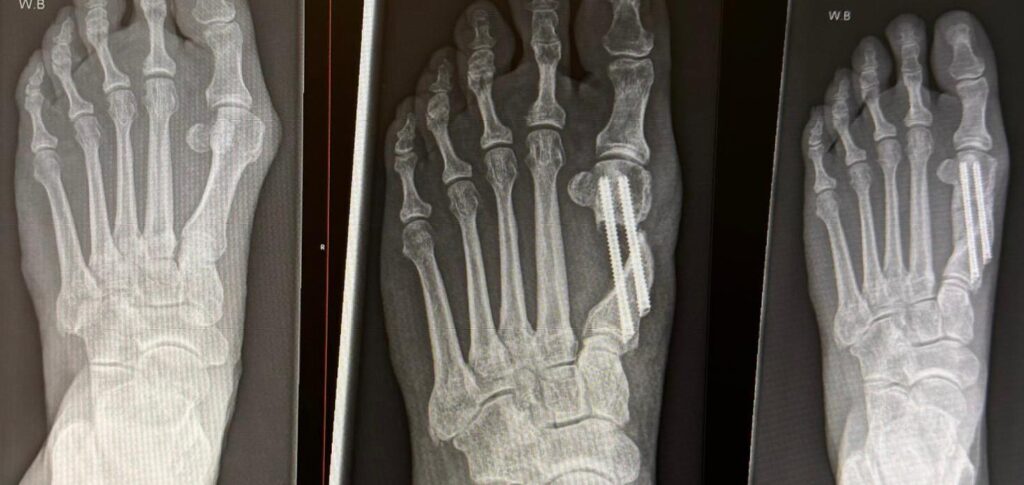 X-ray before and after keyhole bunion surgery showing realignment of the big toe joint