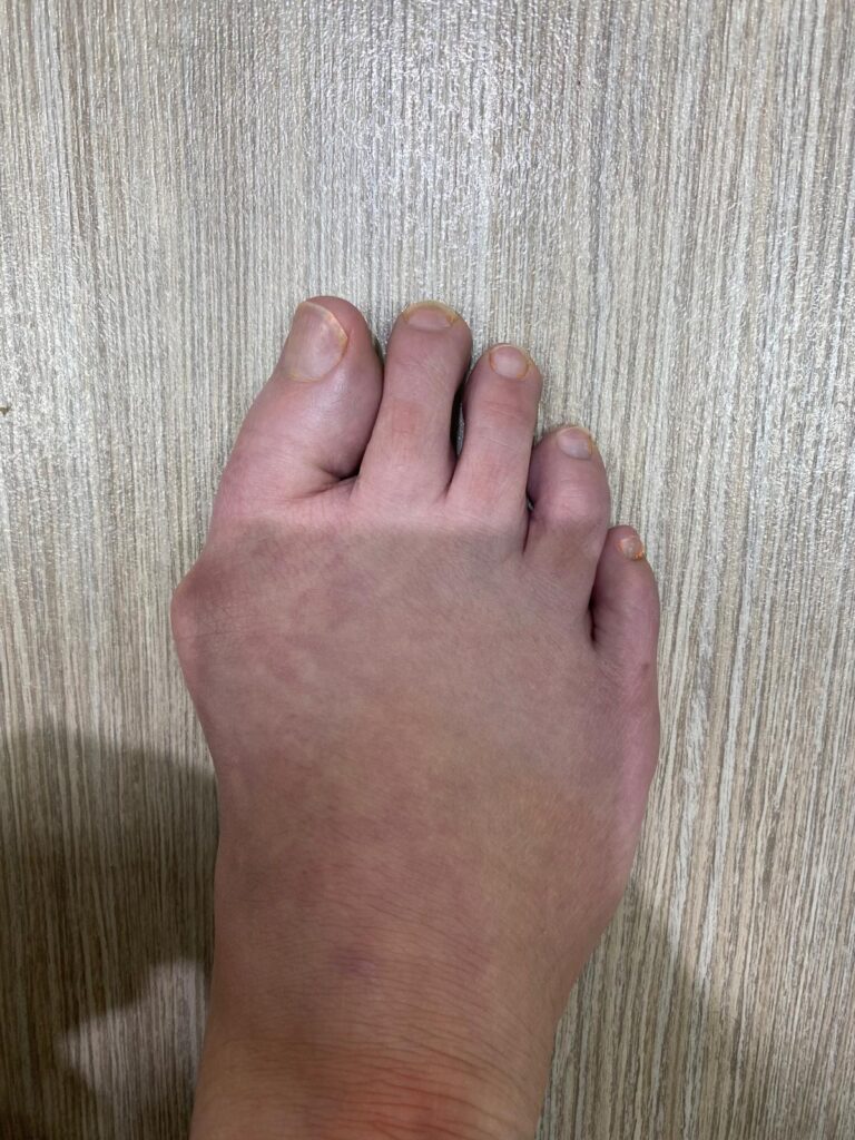 Bunion before keyhole surgery
