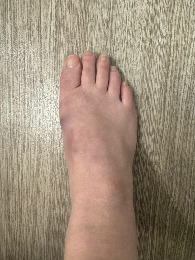 Foot after keyhole bunion surgery
